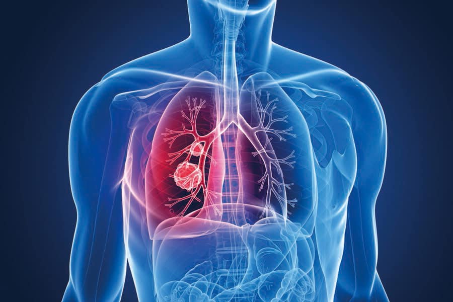 Ελπίδες για ασθενείς με καρκίνο του πνεύμονα