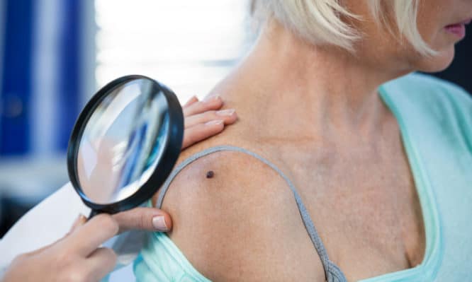Καρκίνος του δέρματος: Πώς μπορεί να εκδηλωθεί μελάνωμα ακόμα και σε όσους ΔΕΝ κάθονται στον ήλιο