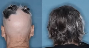 Η σοβαρότητα της αλωπεκίας σε κάθε ασθενή μπορεί να διαφέρει